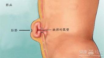 成人脐疝能做运动么吗视频