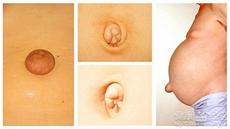 成人脐疝能做运动么吗视频