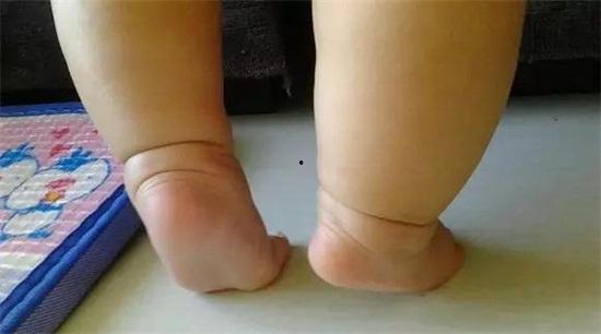 成人矫正脚尖走路视频,跟随专业视频轻松改善步态